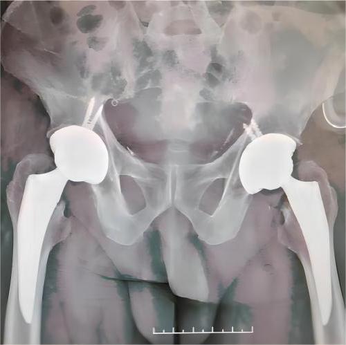 artificial hip replacement case