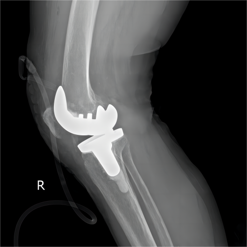 artificial knee replacement case