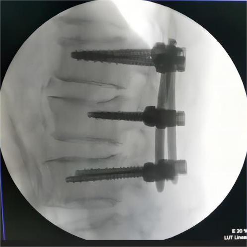 Spine MIS pedicle screw case