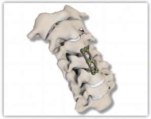 Implantes de columna