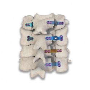 Spine cone and plate fixation systerm