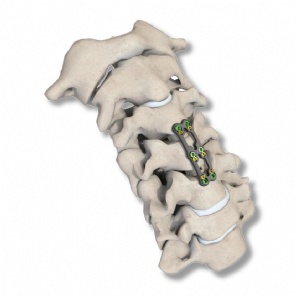 Kit de implante de placa cervical anterior